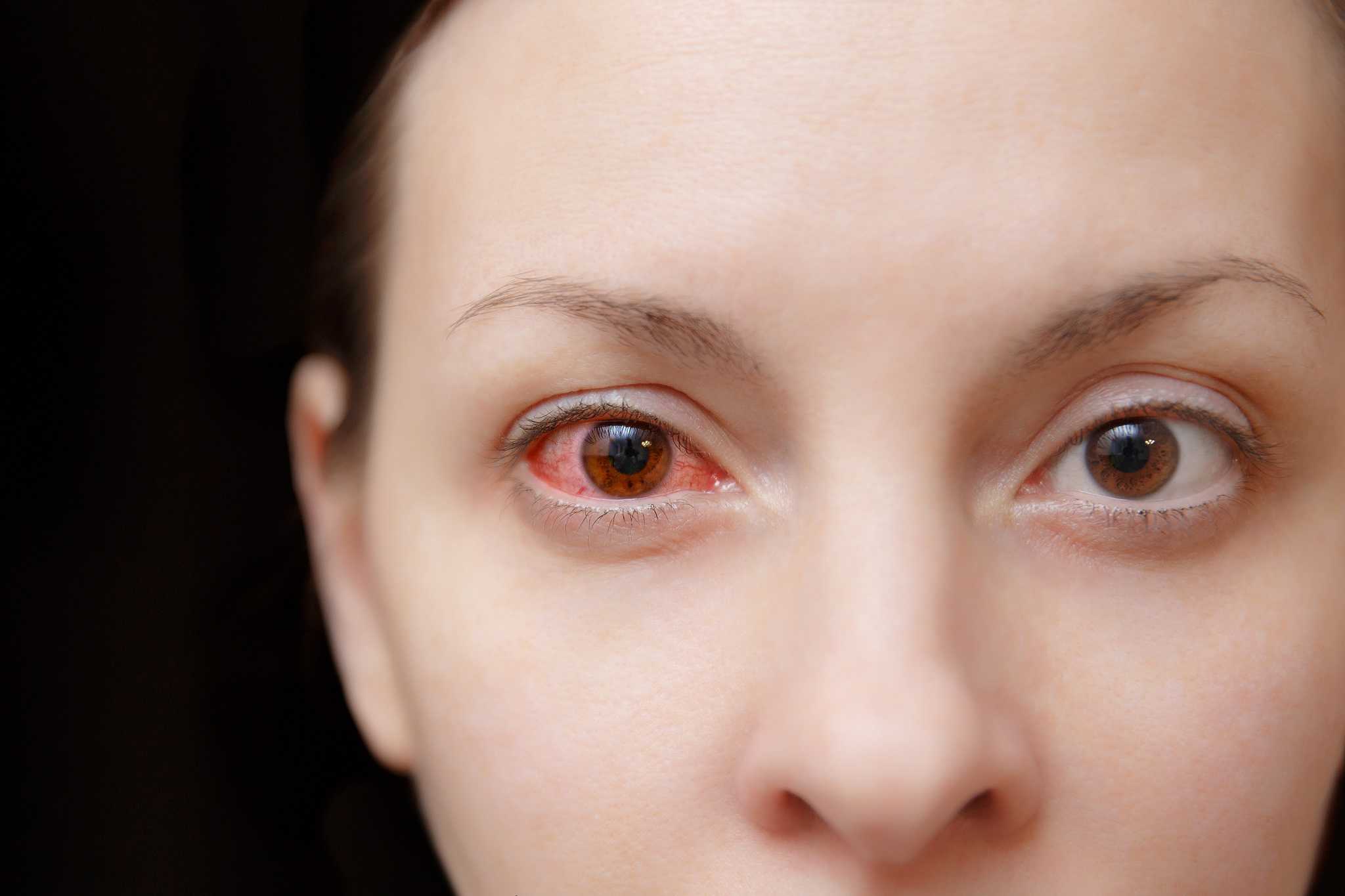 Woman with eye infection