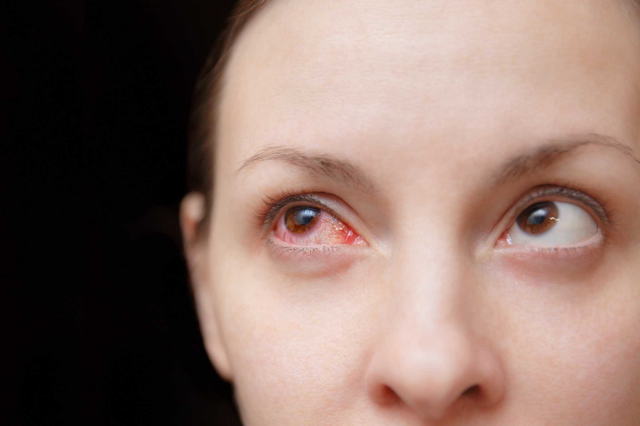 Woman with eye infection