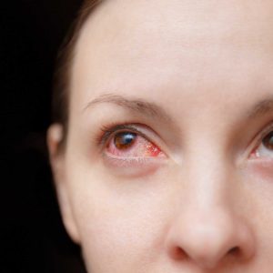 Woman with eye infection