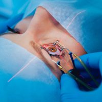 woman having eye surgery